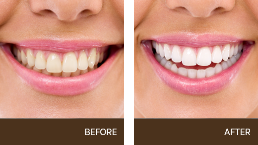 Before & After results case 02 of Teeth Whitening North Bay Smiles, Petaluma, CA
