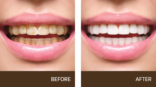 Before & After results of Teeth Whitening North Bay Smiles, Petaluma, CA