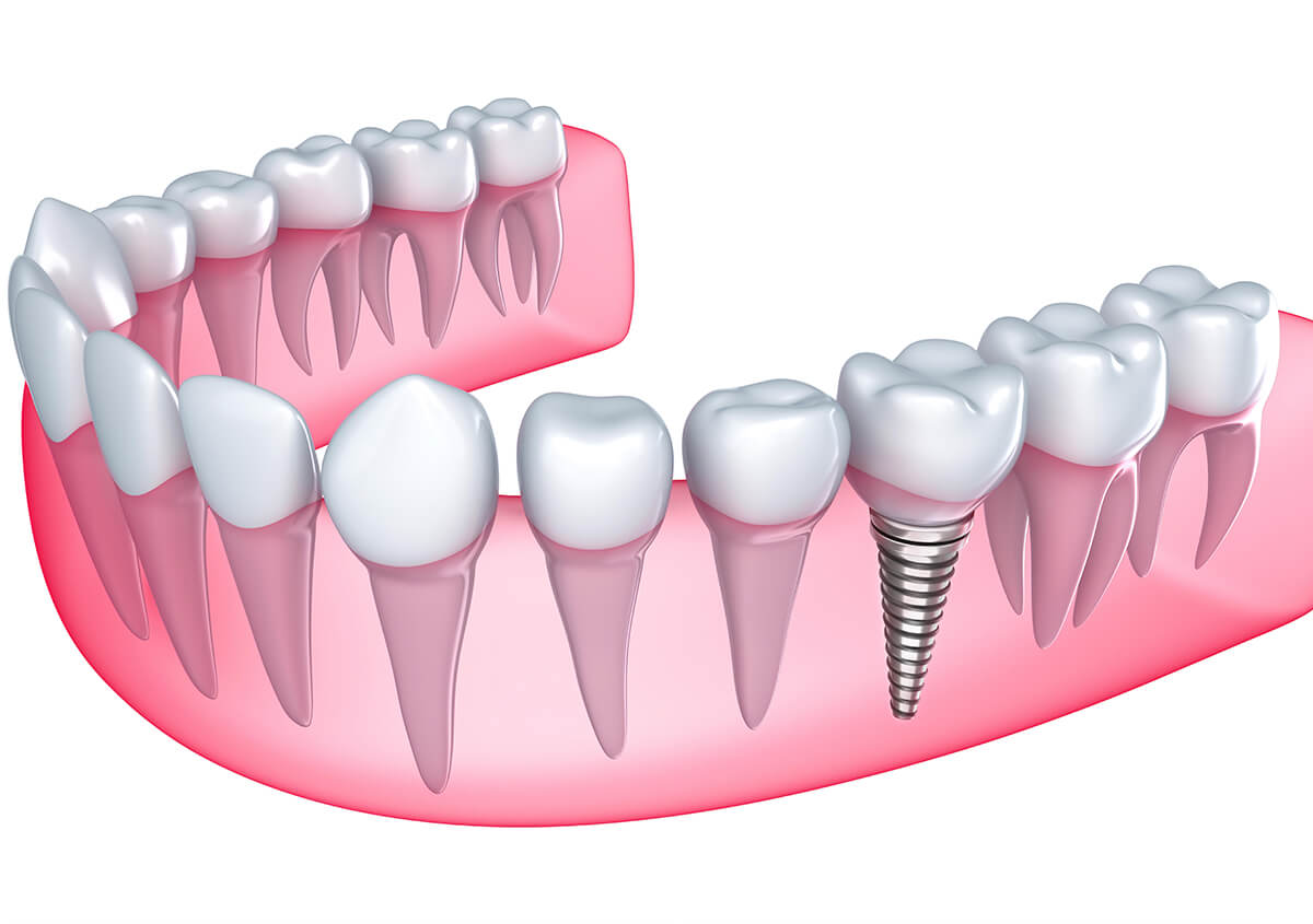 Benefits of Dental Implants for Teeth in Petaluma, CA Area