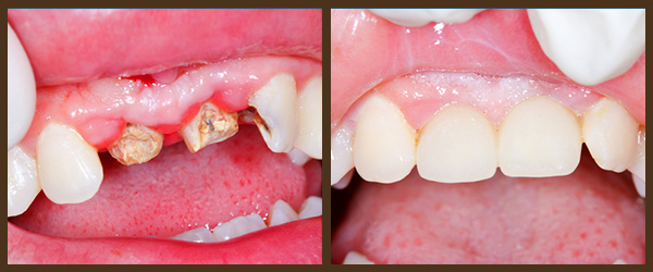 Procera® Crowns before and after results at North Bay Smiles Petaluma, CA cause 1