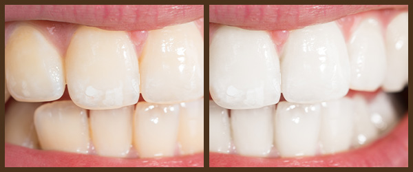 Teeth Whitening before and after results at North Bay Smiles Petaluma, CA