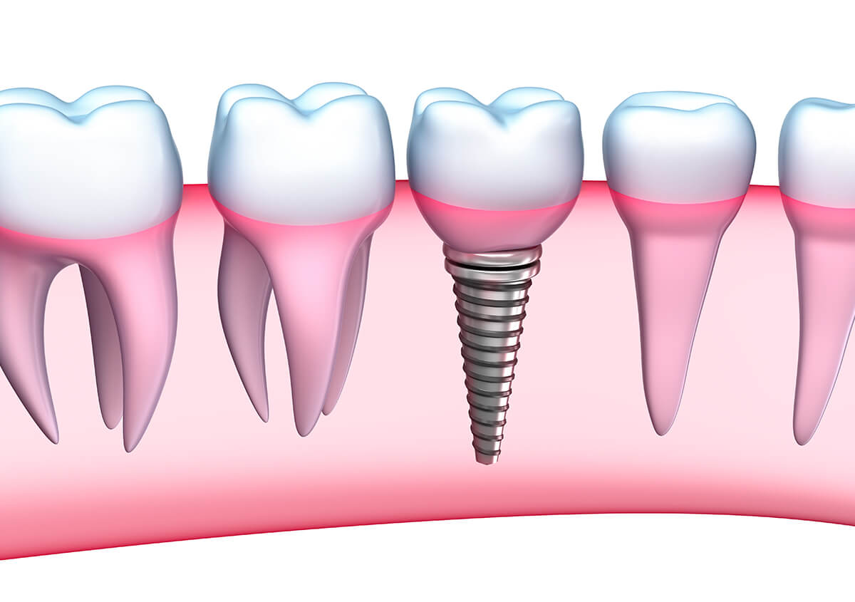 Implant Dentistry in Petaluma CA Area